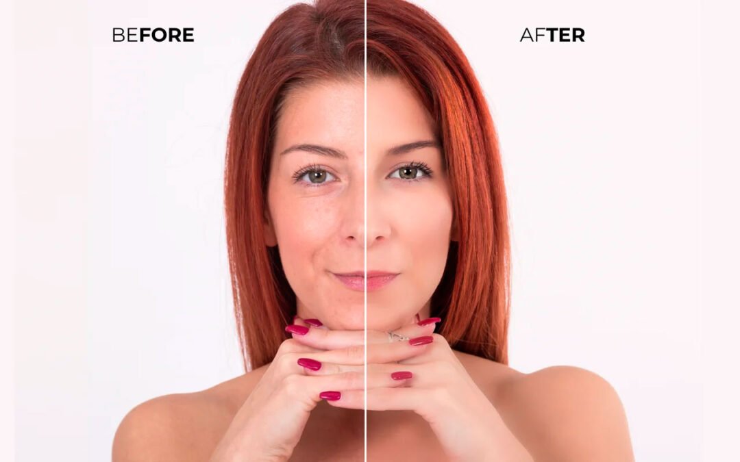 Achieve Firm and Toned Skin without Surgical Intervention: Discover Ultherapy, your best Ally for Skin Transformation